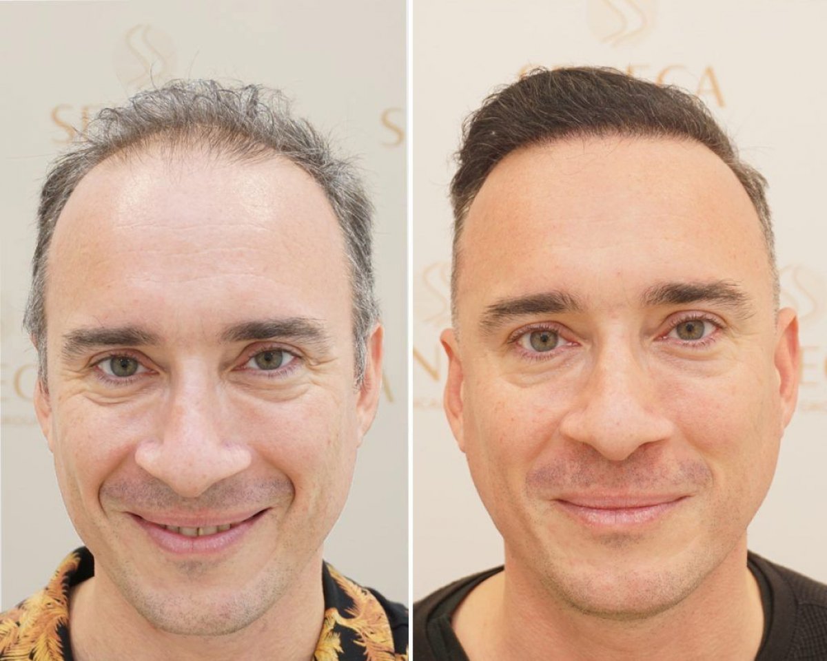 Hair Transplant UK – Why Westminster Medical Group® Stands Out