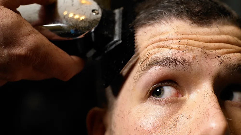 Hair Transplant Turkey: Cost, Techniques, and Clinic Reviews