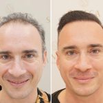 Hair Transplant UK – Why Westminster Medical Group® Stands Out